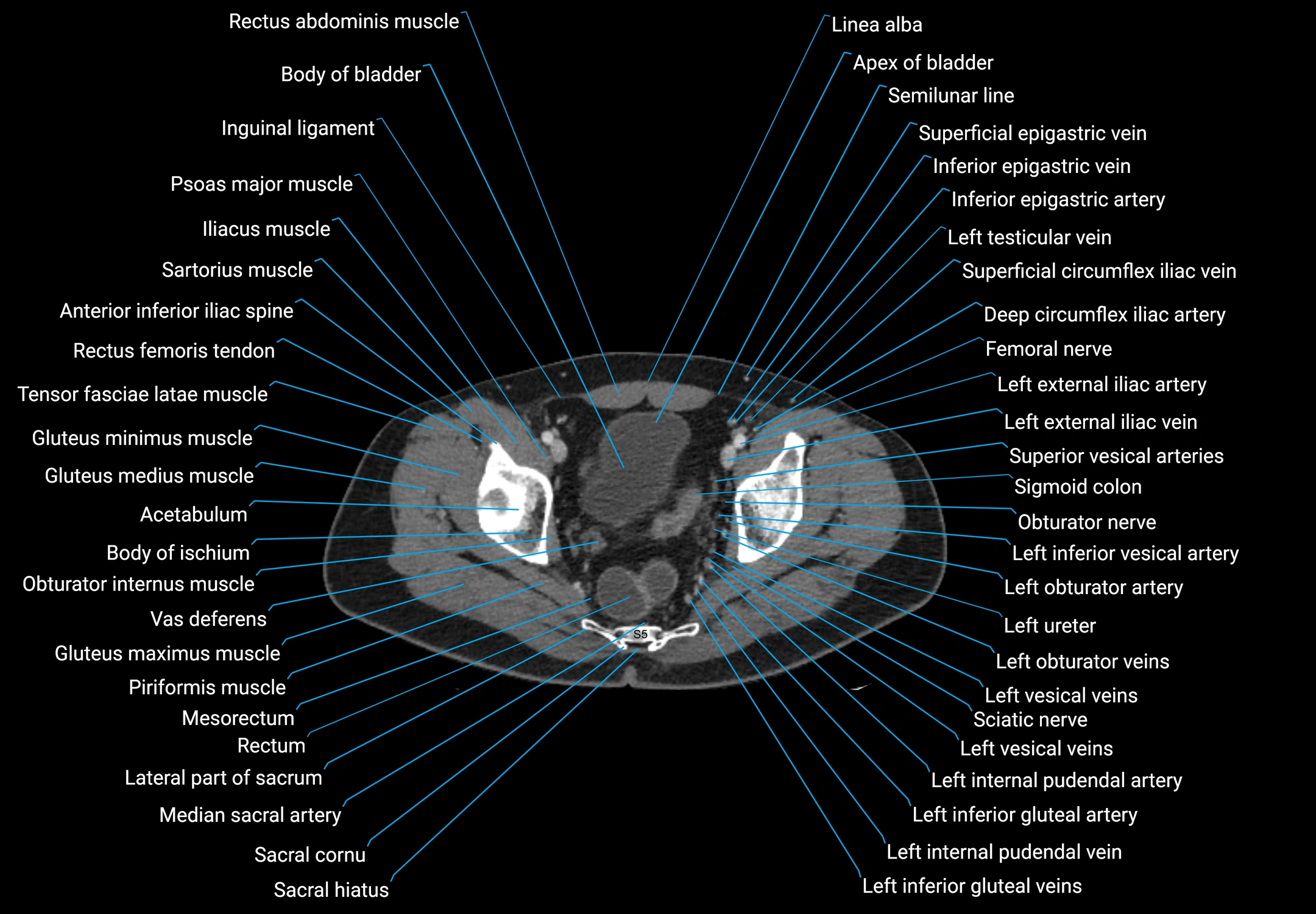 CT male pelvis axial cross sectional anatomy labelled radiology image -00176.webp
